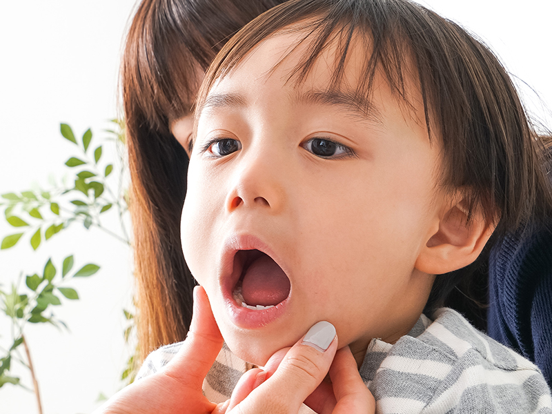 乳歯がむし歯になりやすい理由