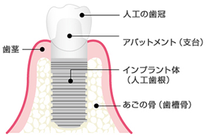 インプラントの構造