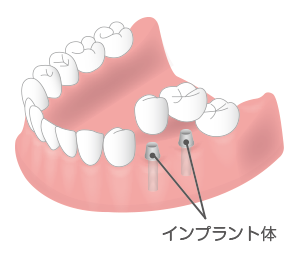 インプラント