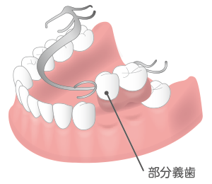 入れ歯（義歯）