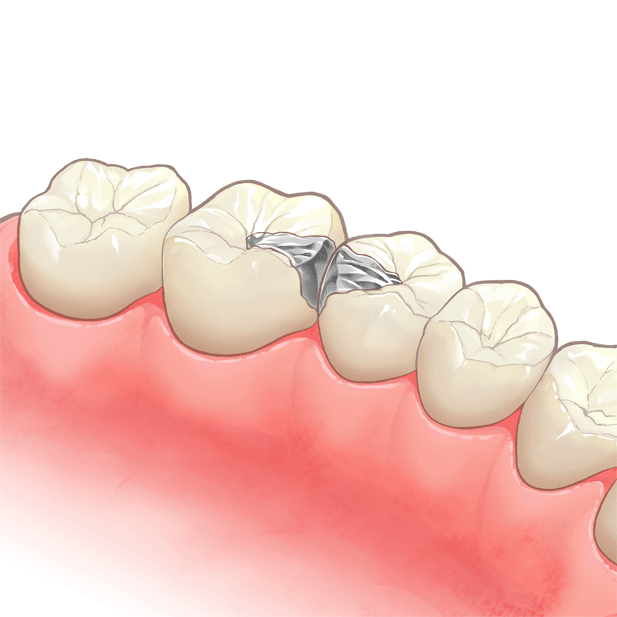 つめもの（インレー）