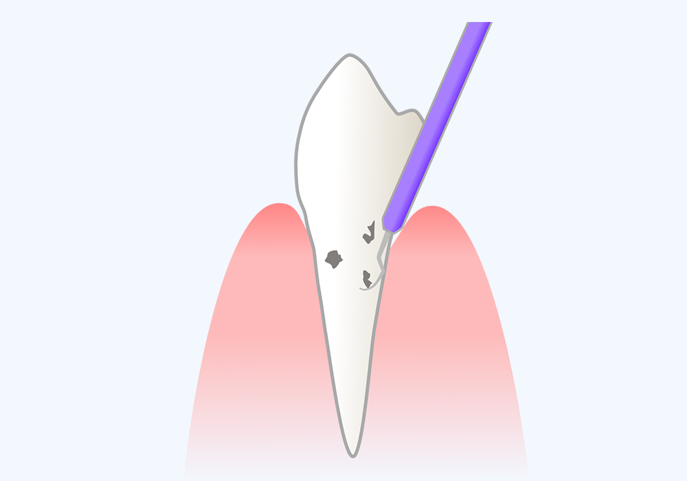 歯石除去